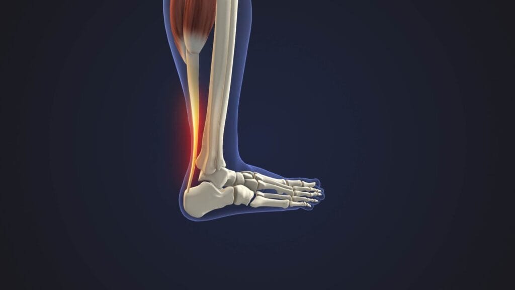 achillessehnenentzündung behandlung